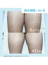 メンズクリア 佐世保店/【メンズクリア】お客様の施術例