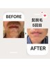 メンズ顔全体脱毛＋【選べる美容液付】