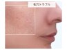 【毛穴縮小/美白/ハリ】リピート率驚愕☆全顔人幹細胞スピキュール全顔導入