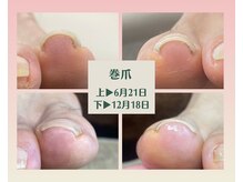 エルモッサ(Hermosa)の雰囲気（巻爪でお悩みのお客様も大歓迎です★矯正テープで簡単にケア♪）