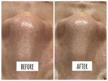 ハオン(HAON)/毛穴洗浄×ハーブピーリング