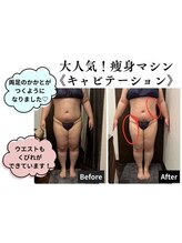 ヴィータローズディセ 名古屋本店(VITA ROSE Desse)/ボコボコセルライトにさよなら