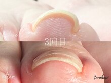 ツメハピ(tumehapi)/フット巻き爪ケア３回目