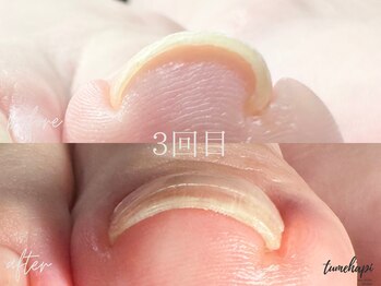 フット巻き爪ケア３回目