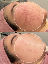 パリスヒロトン(PARIS HIROTON)/アンストレス トリートメント