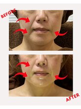 ユーフォリア(Euphoria)/ほうれい線も、フェイスラインも