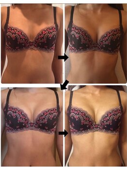 美人バスト 本厚木店/バストアップ◇症例◇