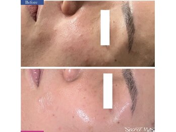 ユフラ(Juhla)/切らない小顔リフト