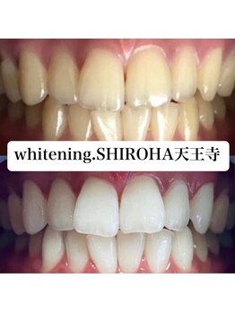 シロハ(SHIROHA)/セルフホワイトニング/天王寺