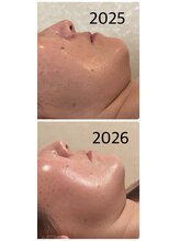 リリィ(RIRY)/フェイシャル　40代