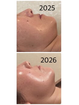 リリィ(RIRY)/フェイシャル 40代