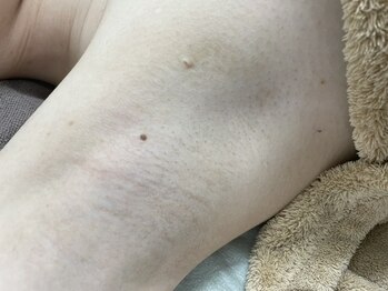 ナノハナ/鹿沼市全身脱毛美容室ナノハナ