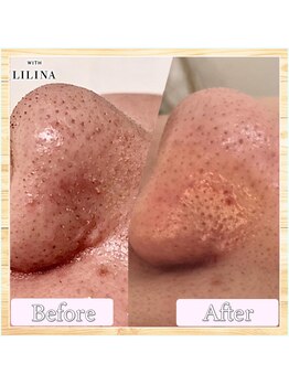 ウィズリリナ 新横浜(with Lilina.)/1回/毛穴洗浄/ハイドラ/新横浜