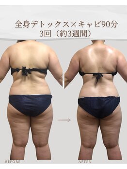 アメリオ(Amelio)/全身+キャビ90分　20代後半