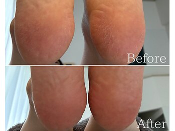 カシェット 広島店(Cachette)/30代女性☆足裏角質ケア90分