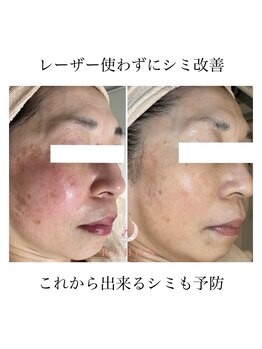 ルボン 宮崎店(RUBON)/RUBON得意のシミ改善