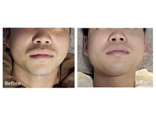 リッカ 学芸大学(RIKKA)/ヒゲ脱毛