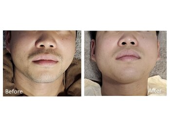 リッカ 学芸大学(RIKKA)/ヒゲ脱毛