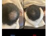 【最上位・育毛促す】ヒト幹細胞培養上清液100%原液 鍼灸75分枠