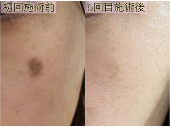 サロンツキ(salon tuki)/【光フォト】症例