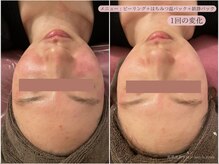 レスイズモア 恵比寿(less is more.)/1回の変化