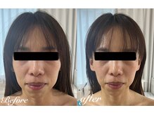 美バストアルファ(美bust α)/【小顔コルギ】症例