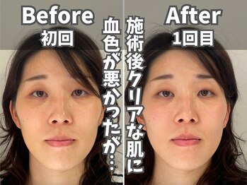 鍼灸整体院ユー(鍼灸整体院You...)/美容鍼×小顔矯正　施術後の変化
