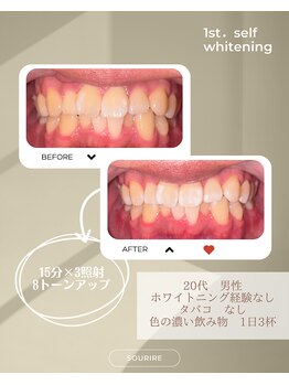 スリール(sourire)/ビフォーアフター