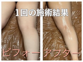 アイル そよら海老江店/【痩身】1回の施術結果☆