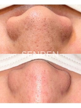 センレン(SENREN)の写真/【隠れ大人気オプション!艶肌フェイシャルワックス】