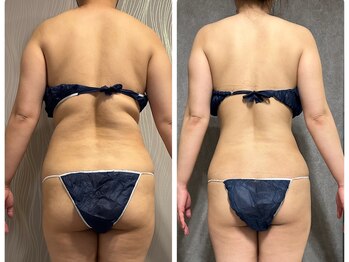 フュース(Futh)/全身セル脂肪ケア