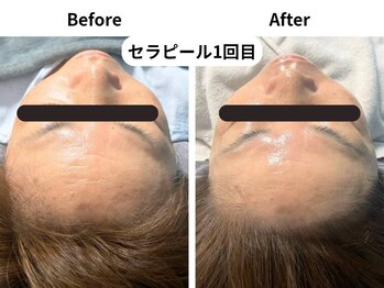 ビー(Be.)/セラピール1回の効果