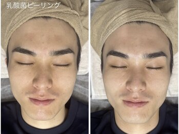 アンリミット 鹿児島天文館店(Une limit)/さらに綺麗な肌に