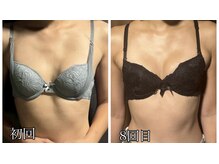 リルマコ/バスト症例写真