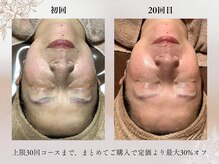 輝き素肌を育てるシミケア美白コース【今なら】\14,300→\3,300