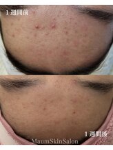 マウム(Maum)/剥かないニキビケア