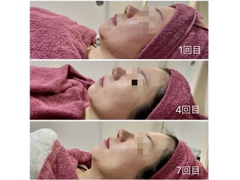 GRACETHOUSAND(グレイスサウザンド)/ハーブピーリング/ニキビケア