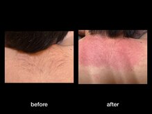 トゥルース(Truth)/美容電気脱毛で終わりある脱毛