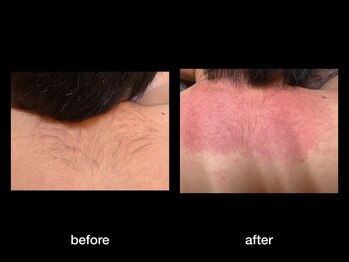 トゥルース(Truth)/美容電気脱毛で終わりある脱毛