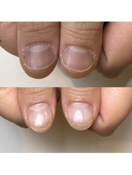 ロイヤル ネイルサロン(Royal nail Saloon)/深爪育成3ヶ月