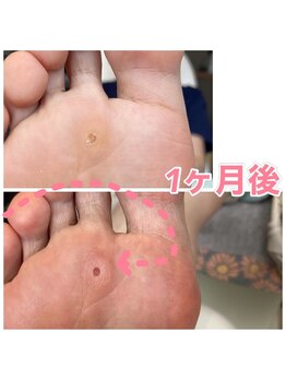 フットファースト 小田原大井町店/魚の目ビフォアアフター