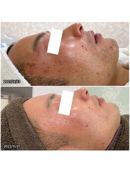 ニキビケア研究所 所沢店/男性のお客様も多数ご来店