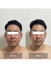 メロウゴールド(Mellow Gold)/最新機器ラジオ波ウィンバック