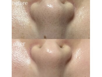 薫風 大阪豊中店/毛穴洗浄