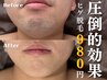 ※5名限定　圧倒的効果◎【メンズ脱毛/ヒゲ脱毛】ヒゲ全体88％OFF　7900→980