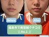【不意の写真に凹まない】3ヶ月集中！小顔徹底引締め美容鍼/初回体験/残1名