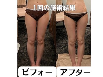 アイル そよら海老江店/【痩身】1回の施術結果☆