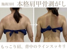 本格肩甲骨剥がし!!もっこり肩、巻き肩、姿勢改善☆