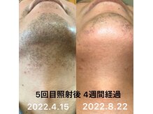 デジールの雰囲気（【メンズ毛穴洗浄＋ヒゲ脱毛】　髭剃りの肌荒れ/ニキビケアに◎）