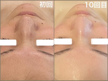 ロージースマイル(Rosy smile)の写真/黒ずみ・詰まりごっそり除去!透明肌へ♪ 【ハイドラ美容液毛穴洗浄】【韓国発 XE`LHAPeel (セラピール】